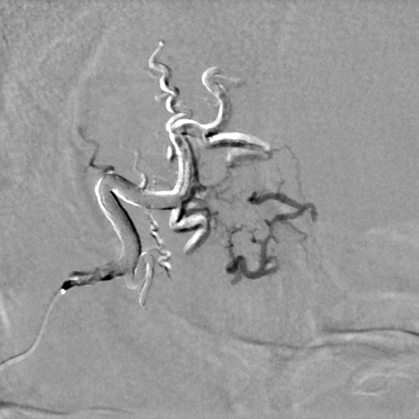 Digitale Subtraktionsangiographie – Stirn