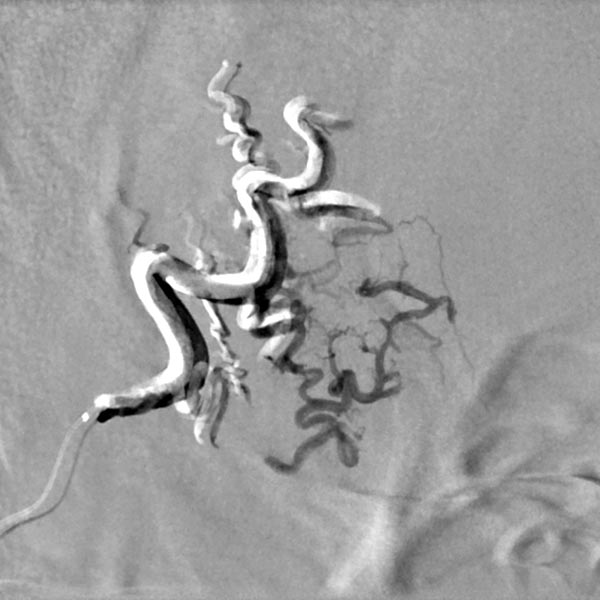 Digitale Subtraktionsangiographie – Stirn