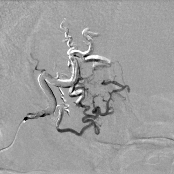 Digitale Subtraktionsangiographie – Stirn