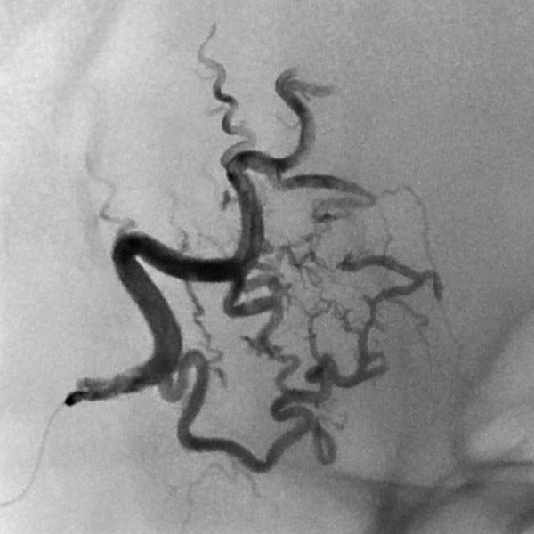 Compgefa: Arteriovenöse Malformation an der Stirn