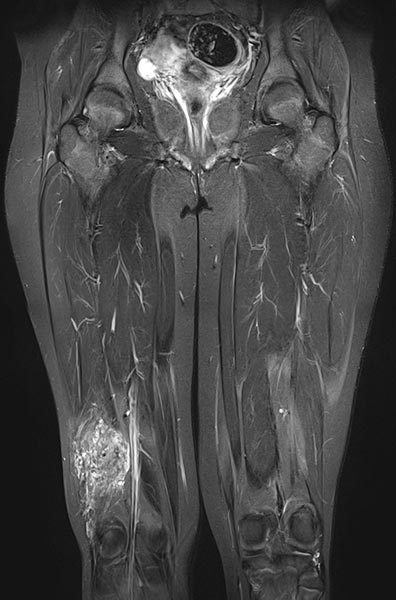 MRT – Venöse Malformation an Oberschenkel