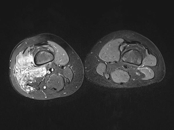 MRT – Venöse Malformation an Oberschenkel