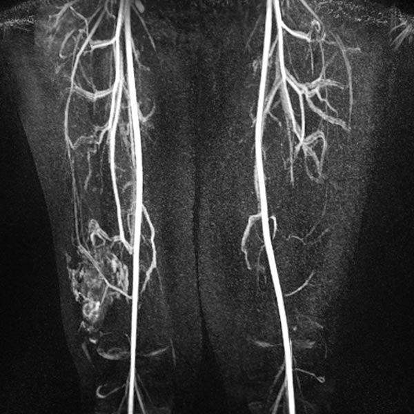 MR-Angiographie – Venöse Malformation an Oberschenkel