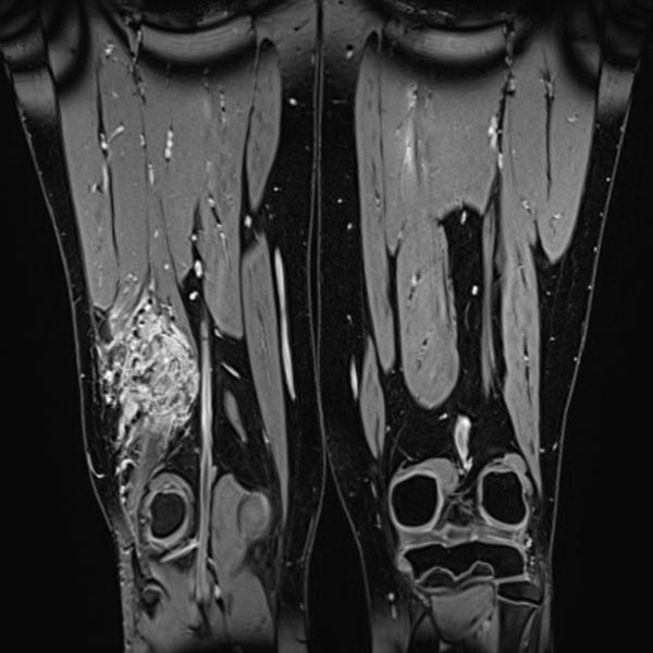 MRT – Venöse Malformation an Oberschenkel