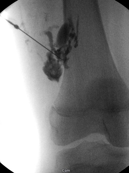 Sklerosierung – Venöse Malformation an Oberschenkel