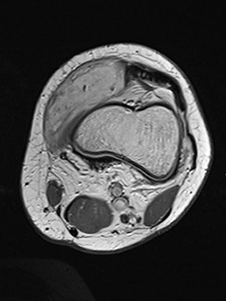 MRT – Venöse Malformation