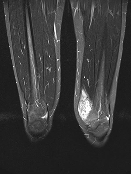 MRT – Venöse Malformation