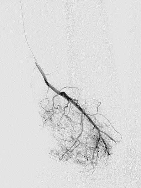 Digitale Subtraktionsangiographie – Venöse Malformation