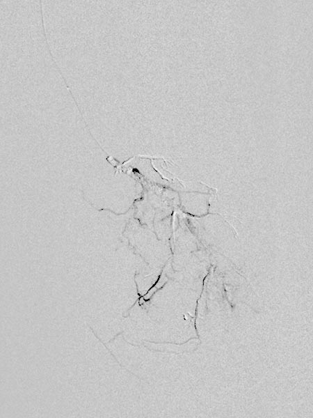 Digitale Subtraktionsangiographie – Venöse Malformation