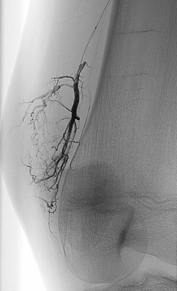 Röntgenbild – Venöse Malformation