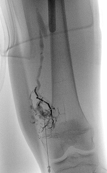 Sklerosierung – Venöse Malformation