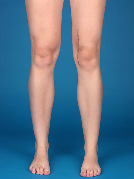 Venöse Malformation – nach erfolgreicher Therapie