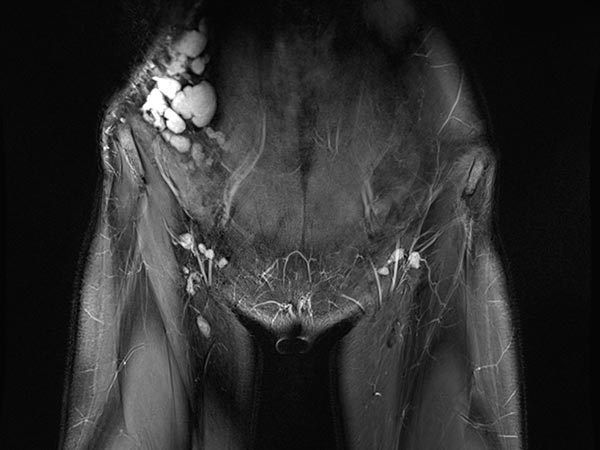 MRT – Lymphatische Malformation an Bauchwand