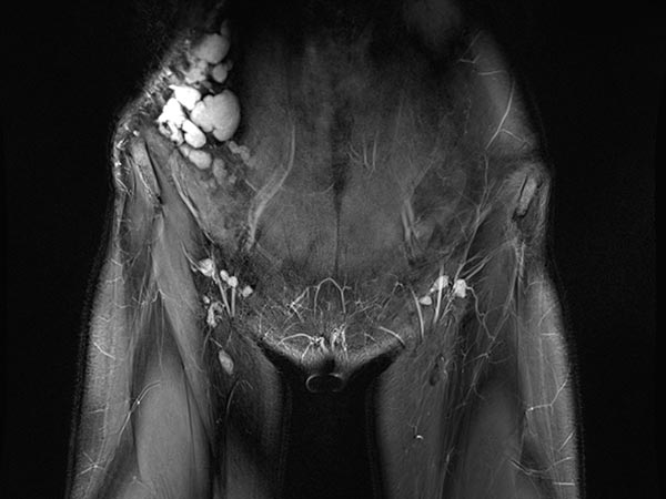 MRT – Lymphatische Malformation an Bauchwand