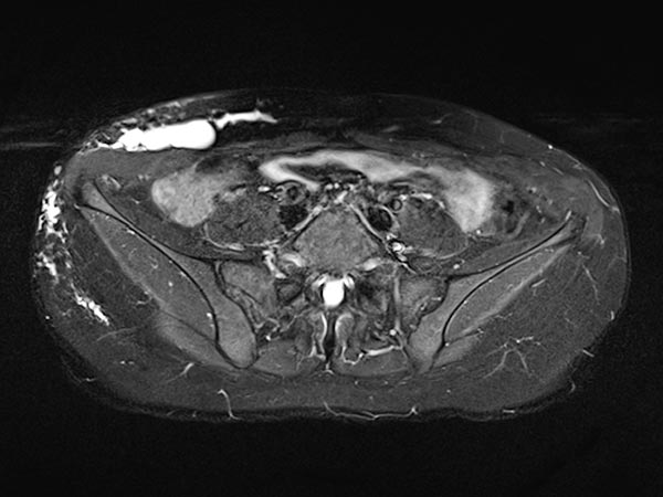 MRT – Lymphatische Malformation an Bauchwand