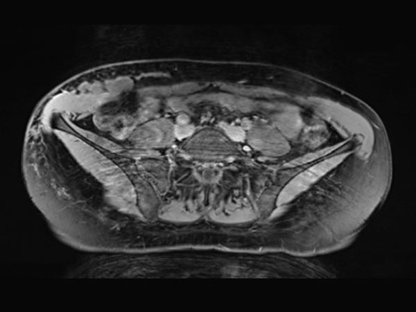 MRT – Lymphatische Malformation an Bauchwand