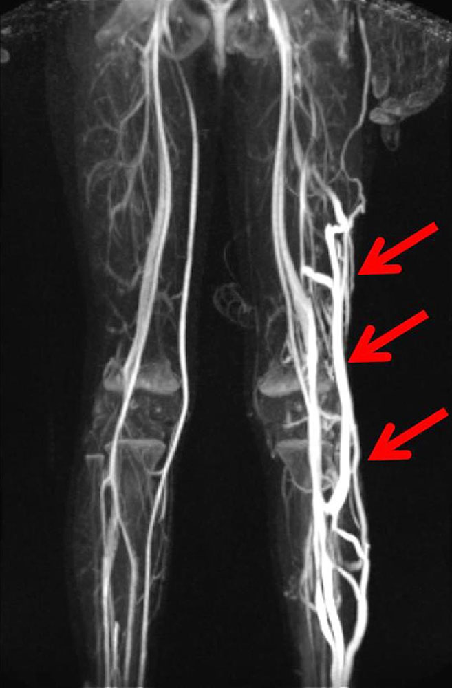 Große, erweiterte Marginalvene lateral am linken Bein