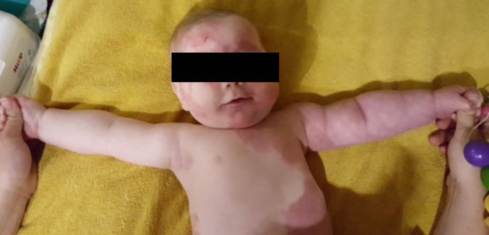 Kleinkind mit Naevus flammeus an Arm und Rumpf – Sturge-Weber-Syndrom