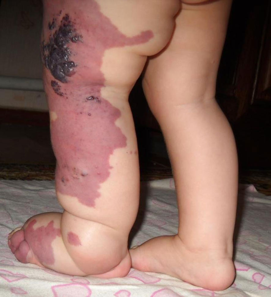 Baby mit Klippel-Trénaunay-Syndrom mit Großwuchs des linken Beins (Hemihyperplasie)