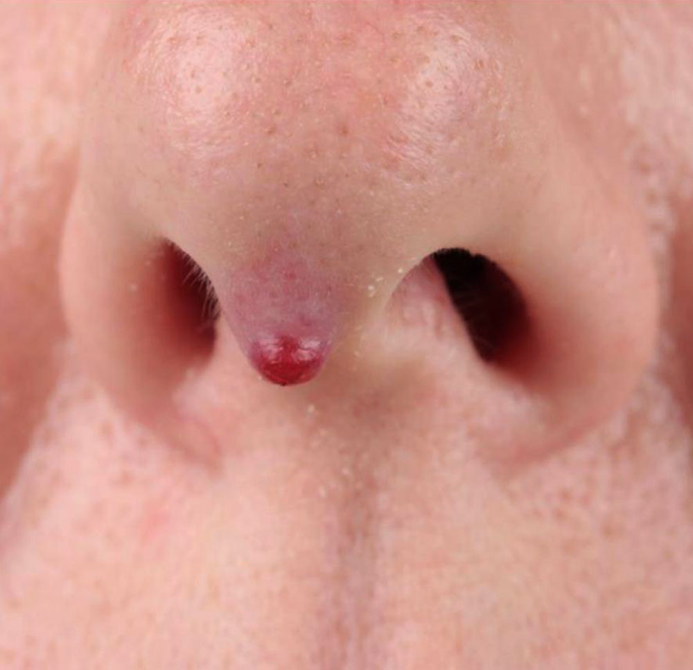 Kleines Granuloma pyogenicum an der Nase