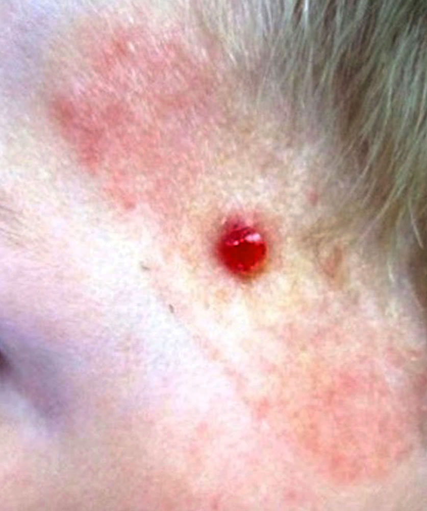 Granuloma pyogenicum an Schläfe bei Kleinkind