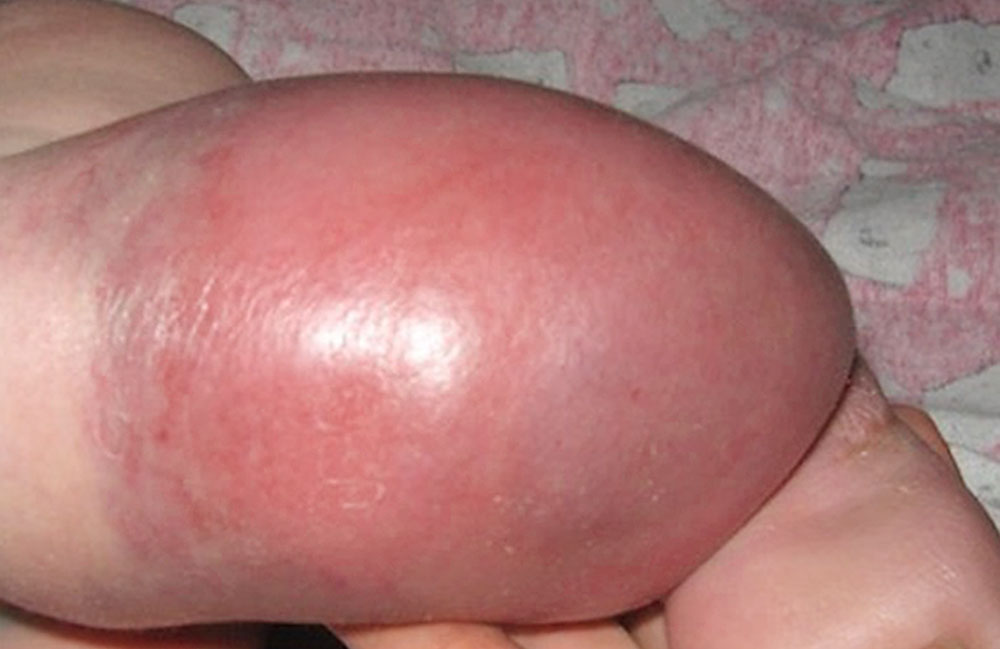 Kaposiformes Hämangioendotheliom Unterschenkel