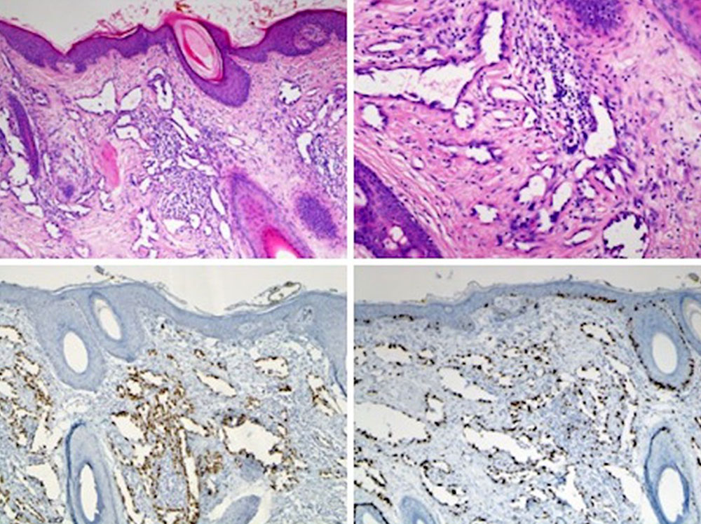 Histopathologisches Präparat eines Angiosarkoms