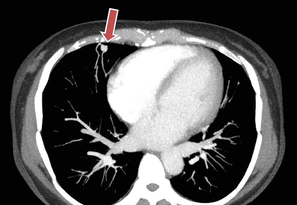 CT – Arteriovenöse Fistel bei Morbus Osler