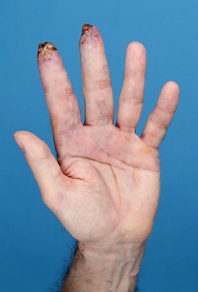 Ulcerationen an Finger