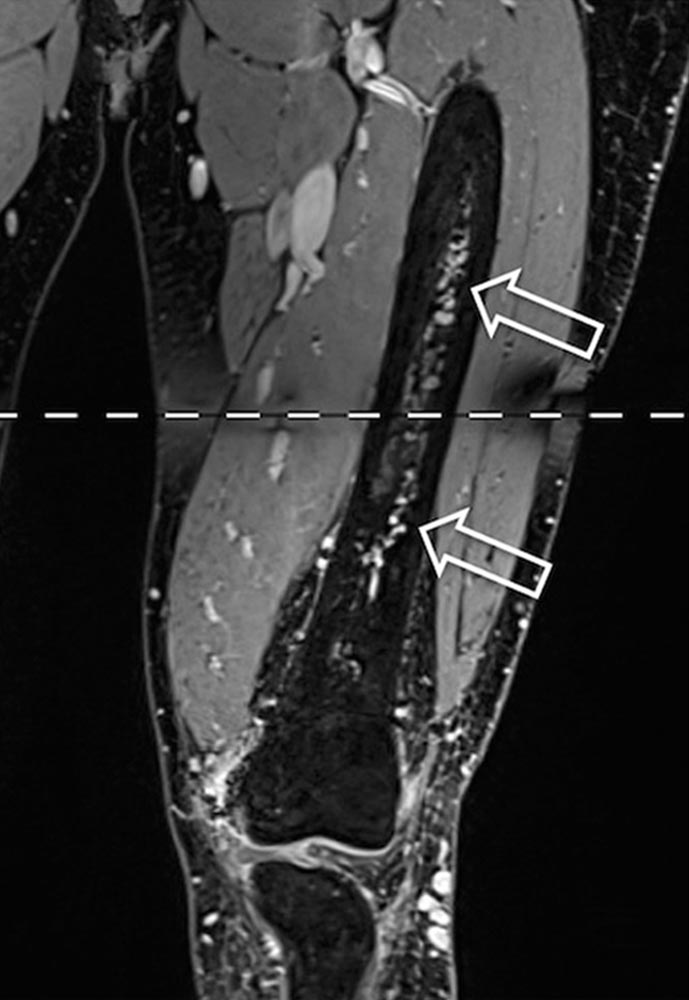 MRT – Arteriovenöse Malformation