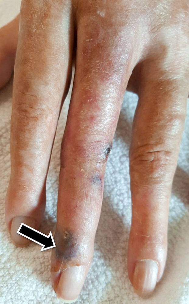 Violett-rötlichen Hautveränderungen bei arteriovenöser Malformation an Finger