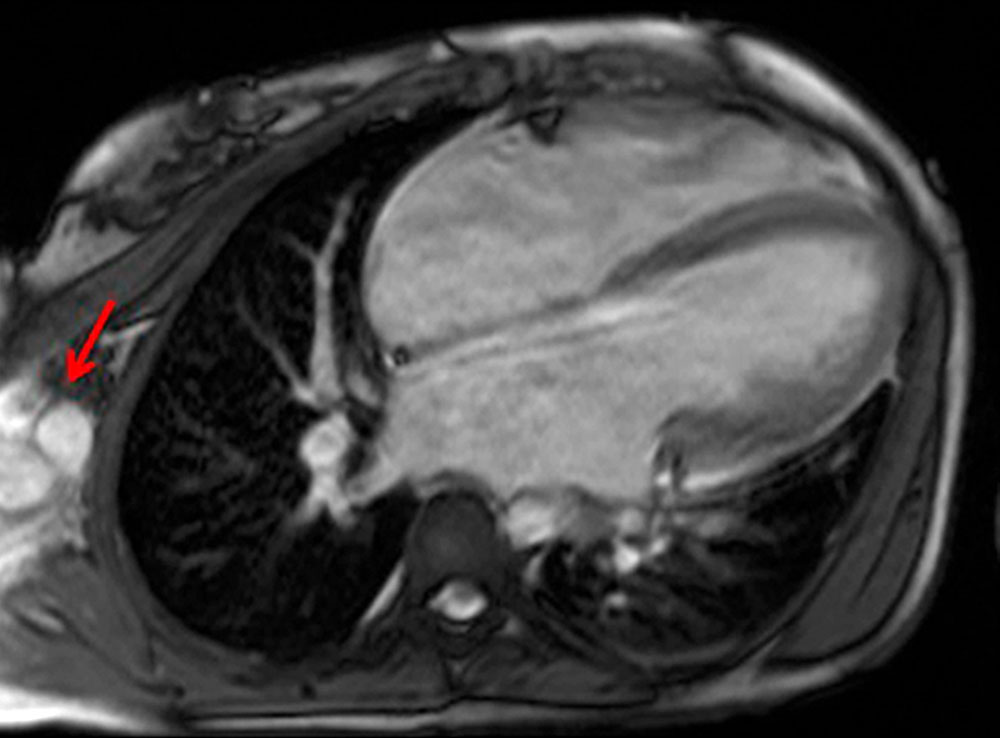 MRT – arteriovenöse Malformation