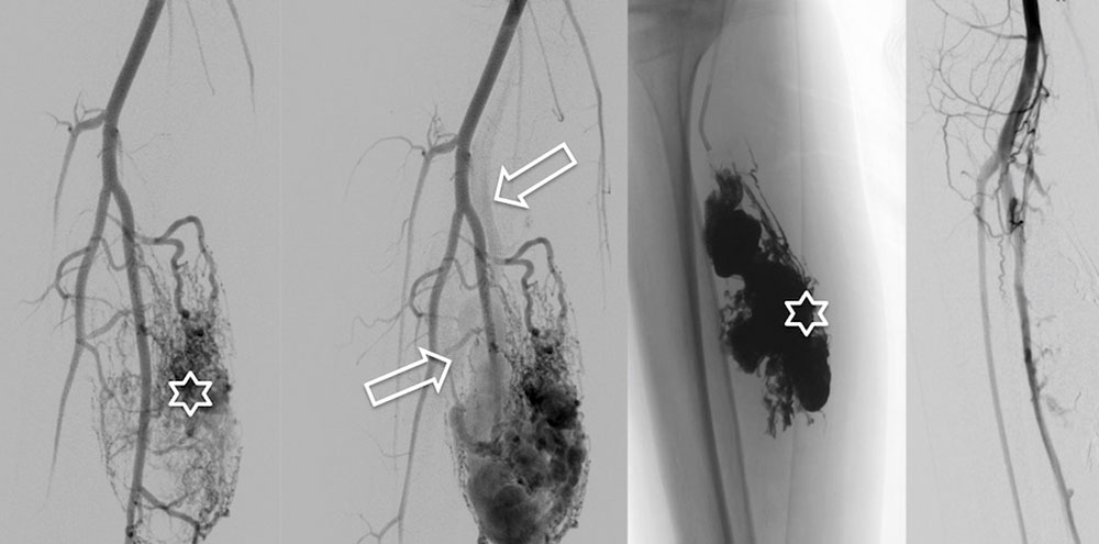 DSA – Arteriovenöse Malformation