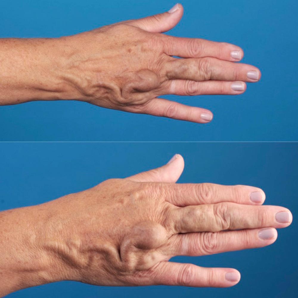 Arteriovenöse Malformation der Hand