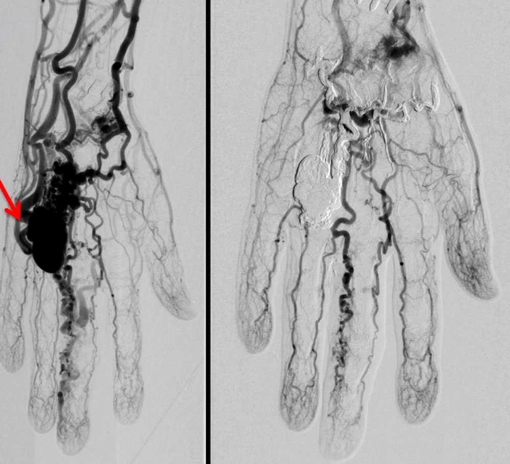 DSA – Aneurysma Hand