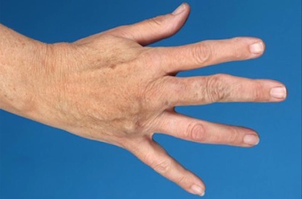 Aneurysma an Finger nach Embolisation