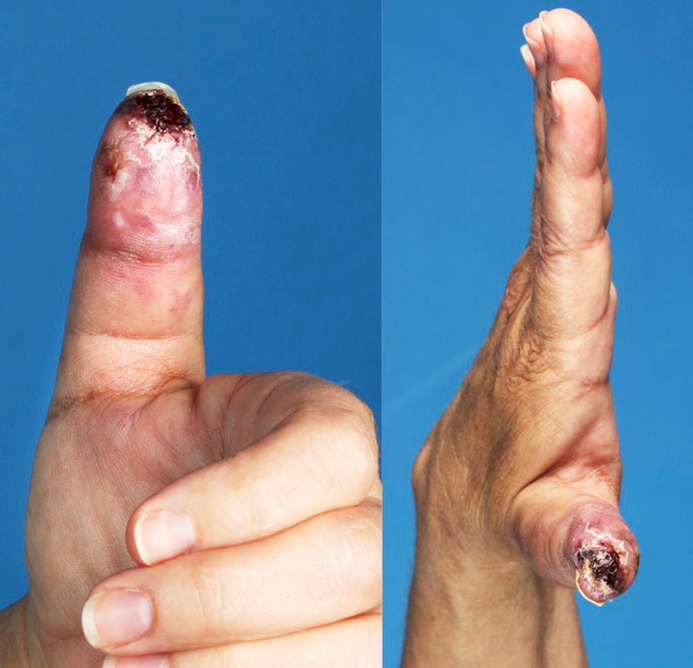 Ulcerationen der Fingerkuppen