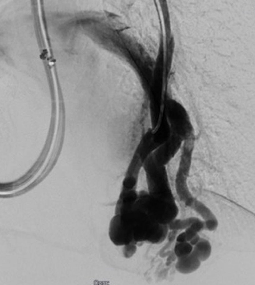 Digitale Subtraktionsangiographie einer pulmonalen arteriovenösen Malformation