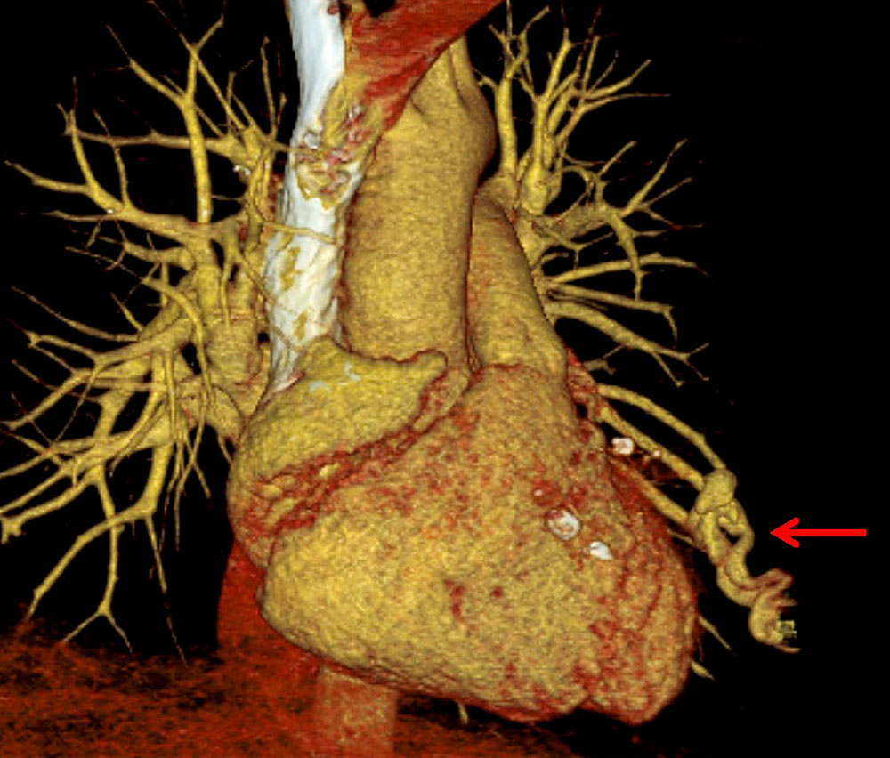 3D Computertomographie der Lunge