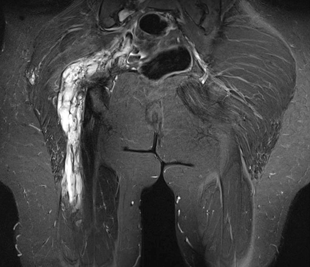 MRT venöse Malformation