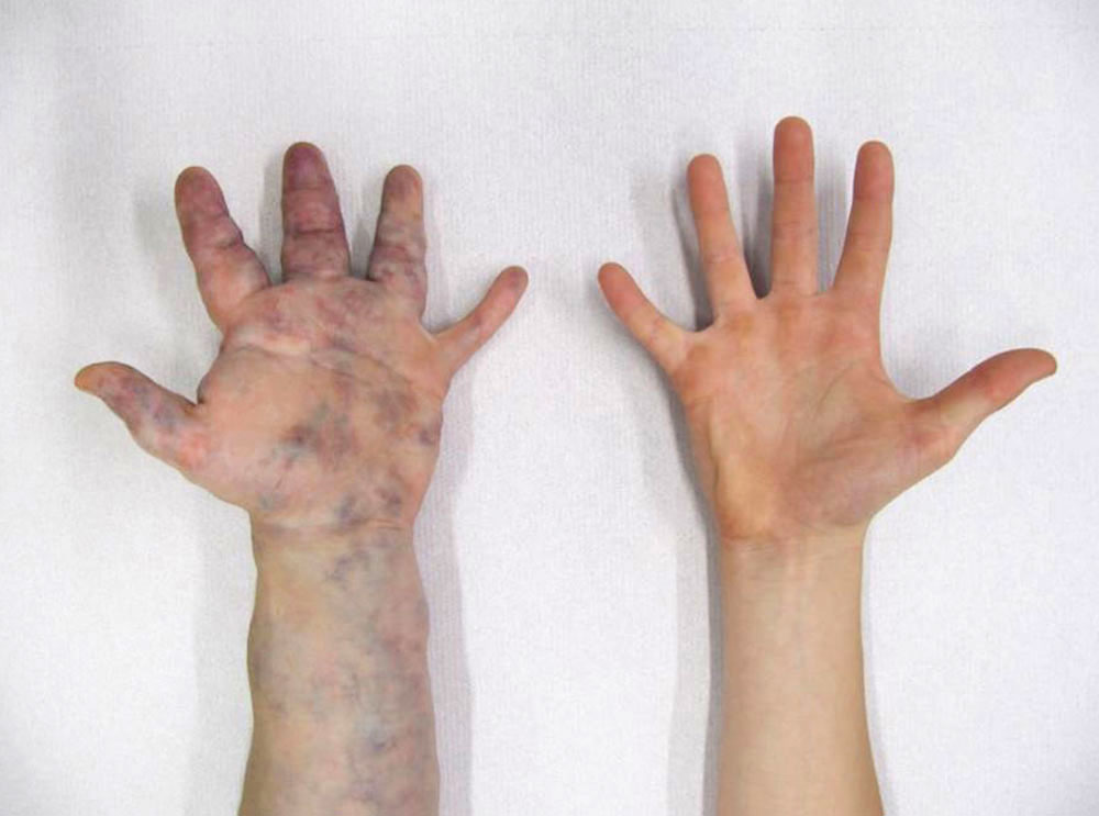 Ausgedehnte venöse Malformation an der linken Hand und Unterarm
