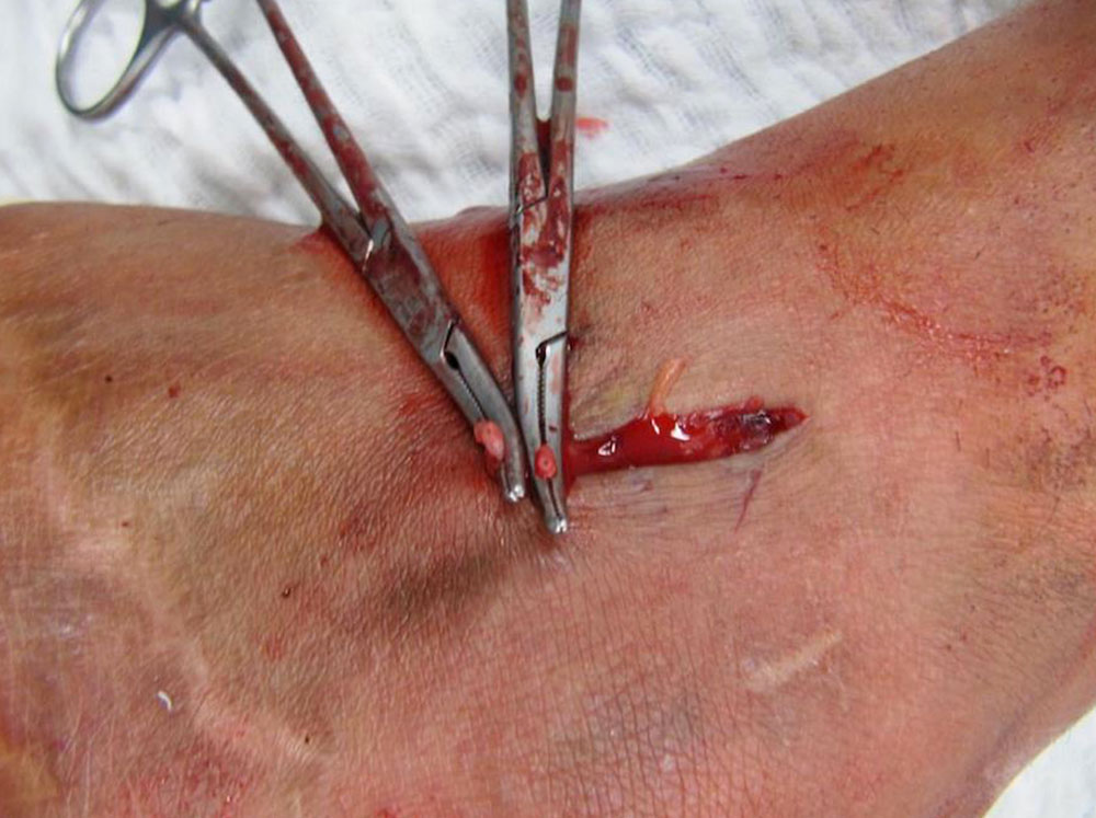 Chirurgischer Situs am Außenknöchel mit einer venösen Malformation