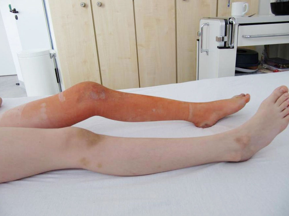 Venöse Malformation an Knie und Fuß