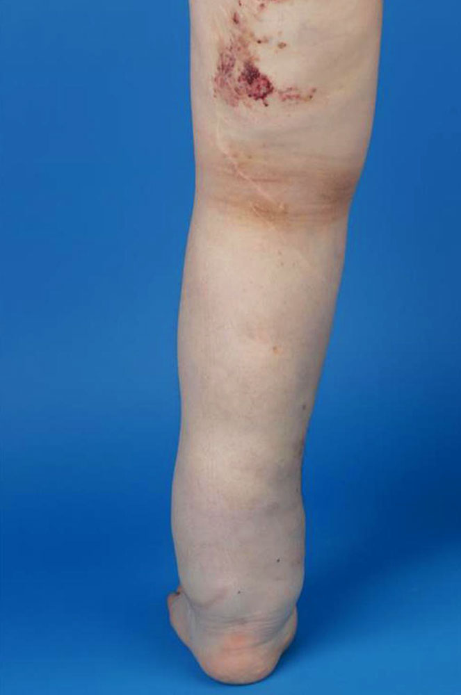 Lymphödem und lymphatische Malformation - Bein
