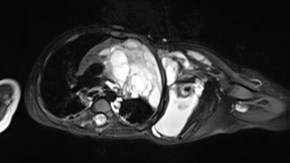 Intrathorakale makrozystische lymphatische Malformation im Schulter-Hals-Bereich