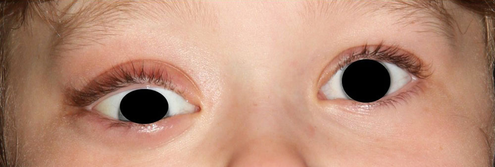 Intraorbitale lymphatische Malformation - Auge