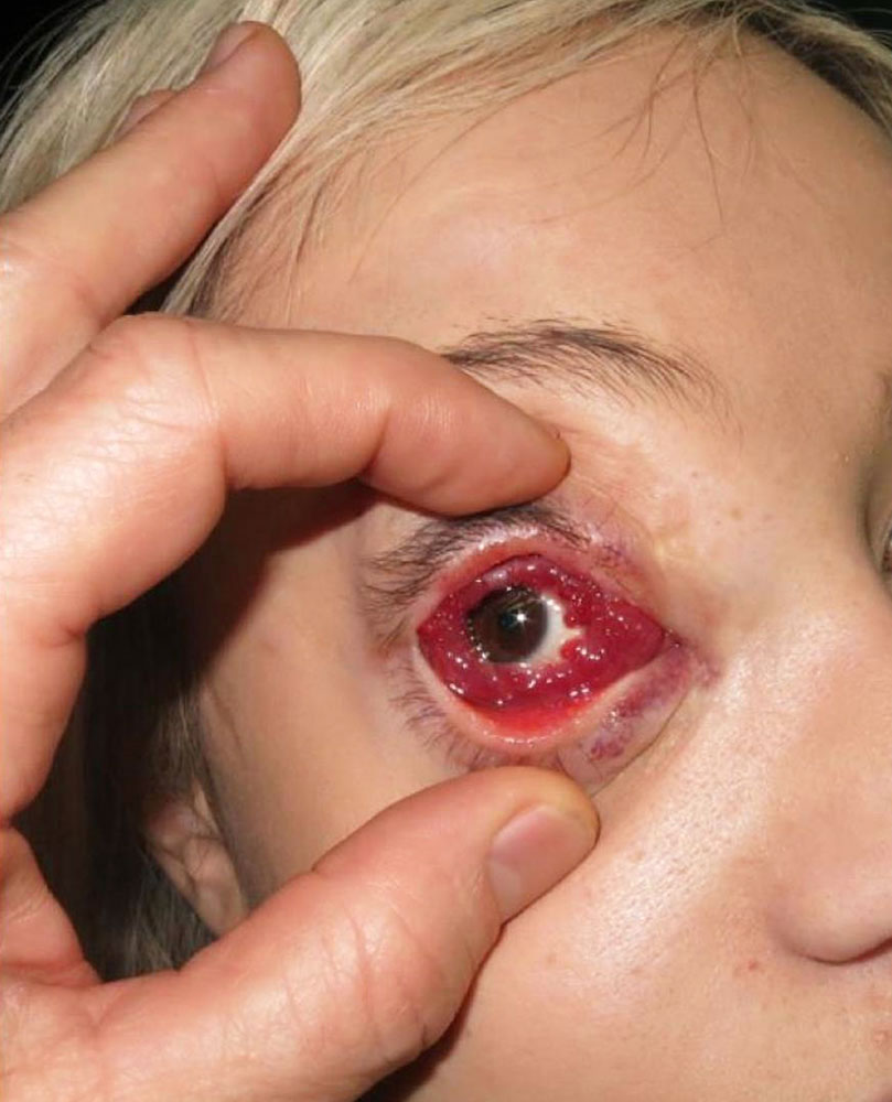 Lymphatische Malformation - Conjunctiva