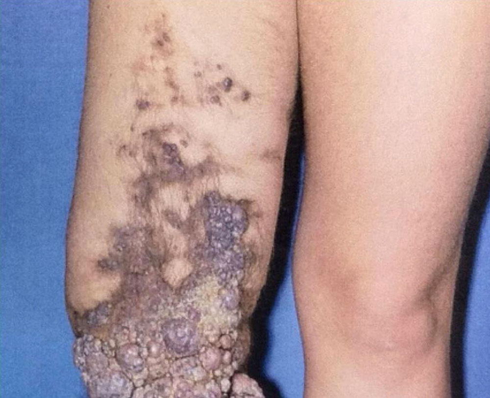 Mikrozystische lymphatische Malformation am Bein