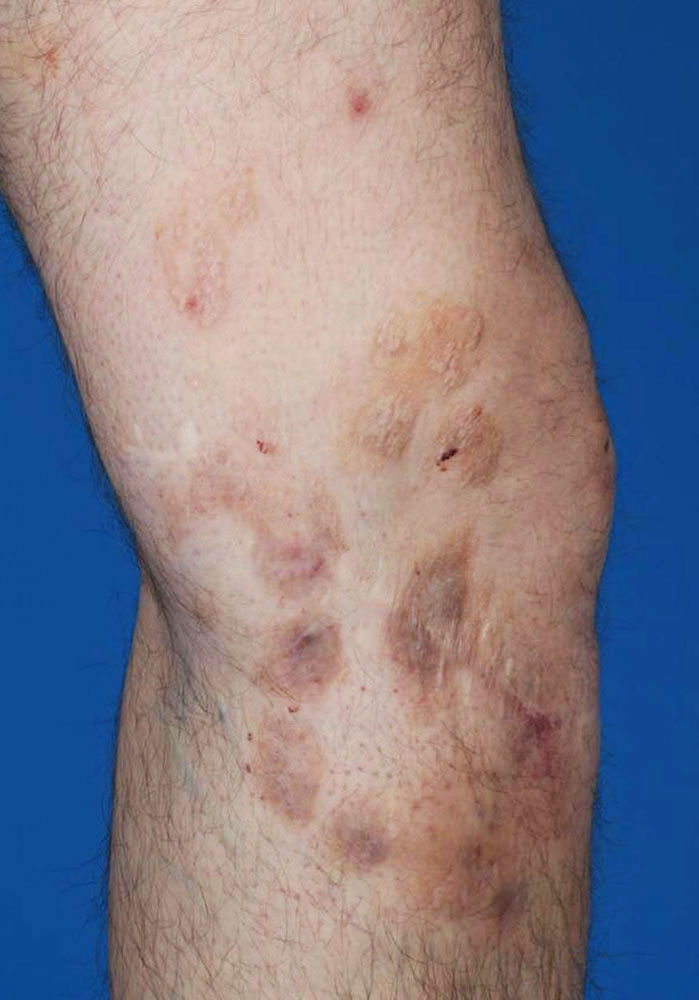 Multiple Hautläsionen durch lymphatische Malformation