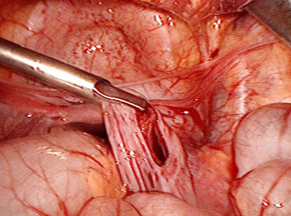 Intraoperatives Bild einer laparoskopischen Resektion